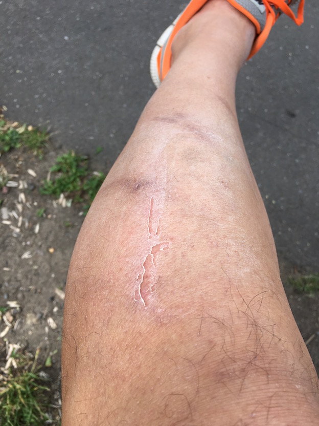 left leg hit by van